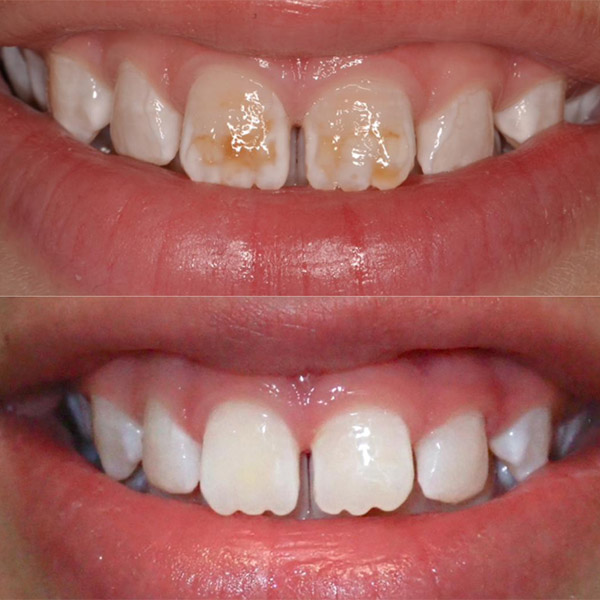 Before and after anterior MIH teeth ICON treatment